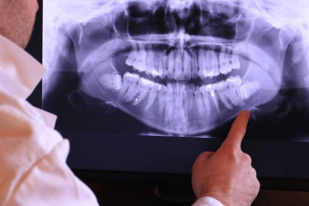 Best Emergency Tooth Extraction in Monticello, MS