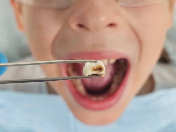 Best Emergency Broken Tooth Repair in Monticello, MS